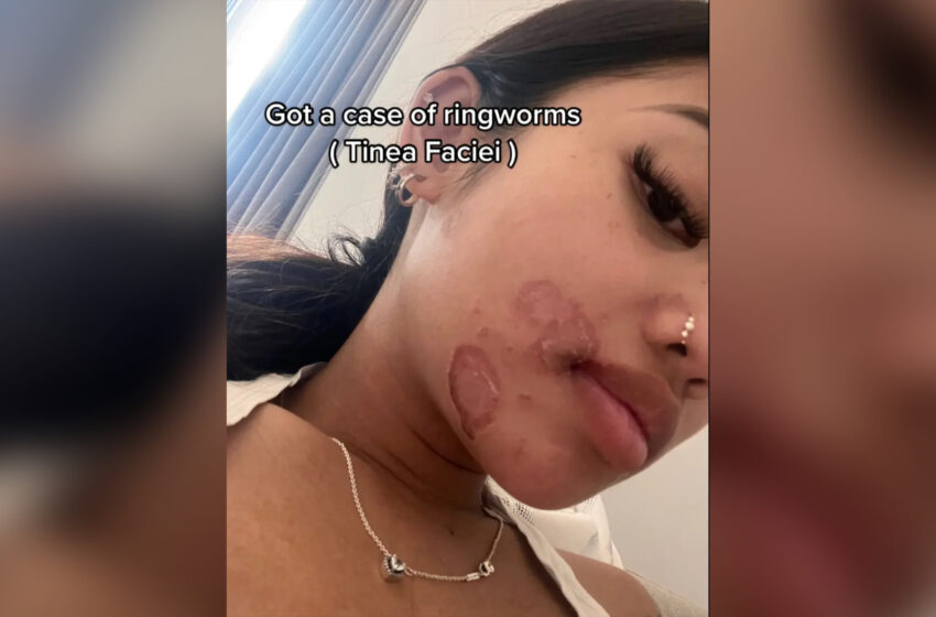 TikToker Claims She Got Ringworm’s All Over Her Face After Sharing Makeup Brushes with Friends