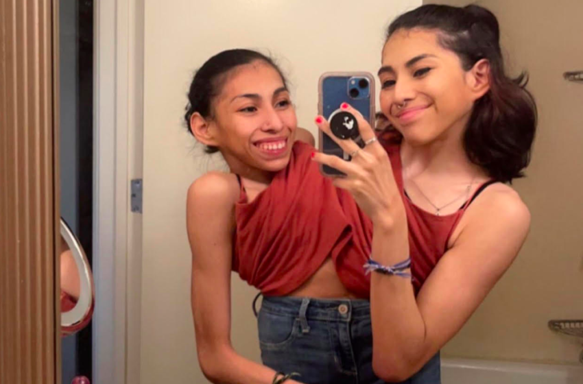 Conjoined Twin Sisters Who Share Pelvis Reveal What It’s Like With One Of Them Having A Boyfriend