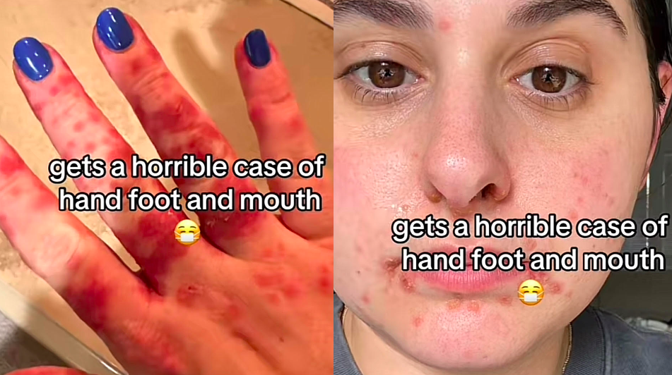 A video that gained widespread attention on TikTok featured a mother revealing that both she and her child were infected with hand-foot-and-mouth disease from a Grocery Store shopping cart.